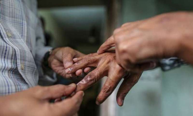 पर्सामा १ सय २४ कुष्ठरोगीले उपचार सेवा लिँदै